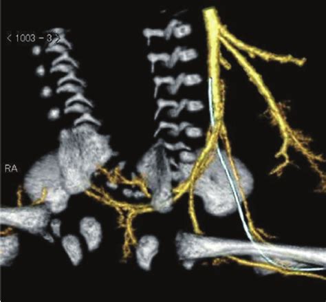 Images Of Multidetector Computed Tomography Mdct Angiography Of The