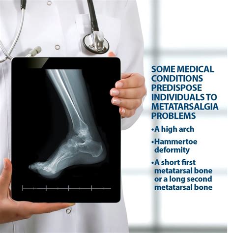 Metatarsalgia Surgery Florida Orthopaedic Institute