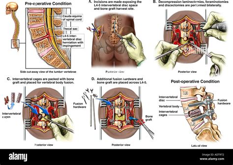 Lumbar Foraminotomy