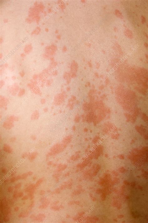 Erythema Multiforme Stock Image M1500336 Science Photo Library