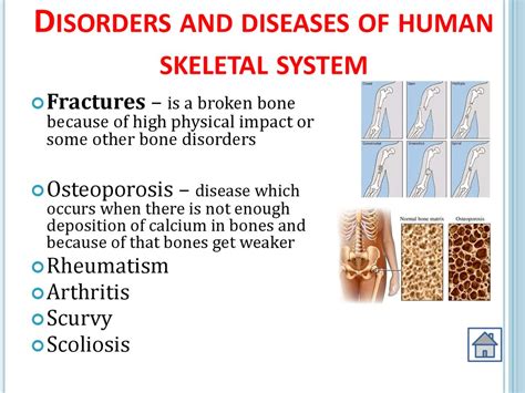 Disease In Skeletal System Captions Trend Today