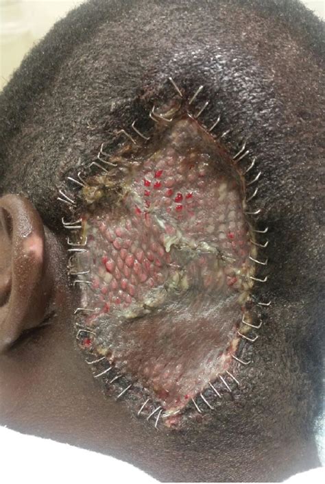A Case Of Squamous Cell Carcinoma Of The Scalp In An