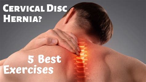 Cervical Disc Herniation Exercises In This Video We Will Learn Best
