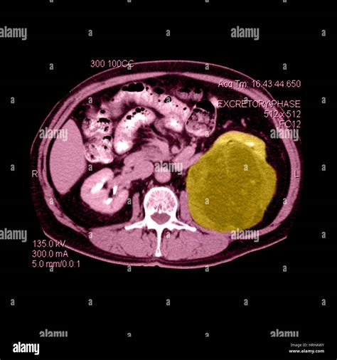 Abnormal Ct Of Abdomen Hi Res Stock Photography And Images Alamy