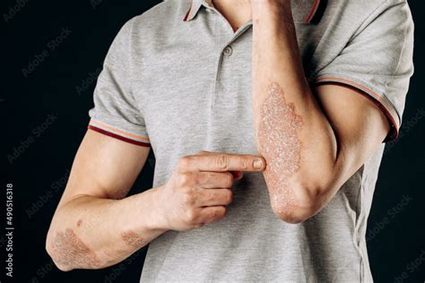 Acute Psoriasis On The Elbows Is An Autoimmune Incurable Dermatological