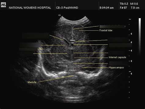 Axial Neonatal Head Ultrasound Diagram Quizlet