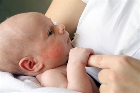 Dermatiti Nei Bambini Riconoscerle E Curarle Pediatrico Roma Bios Spa