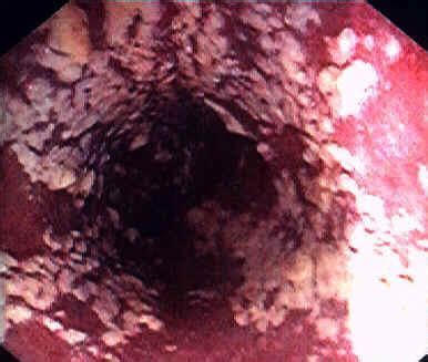 Keputihan saat hamil muda apakah normal atau justru berbahaya. Keputihan…. Apa? Penyebab? Cara untuk atasi? | Pad Herba ...