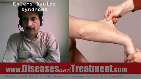 Ehlers Danlos Syndrome Causes Diagnosis Symptoms Treatment