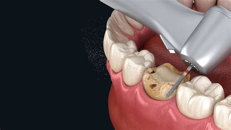 Caries Treatment Star 28 Dental Clinic