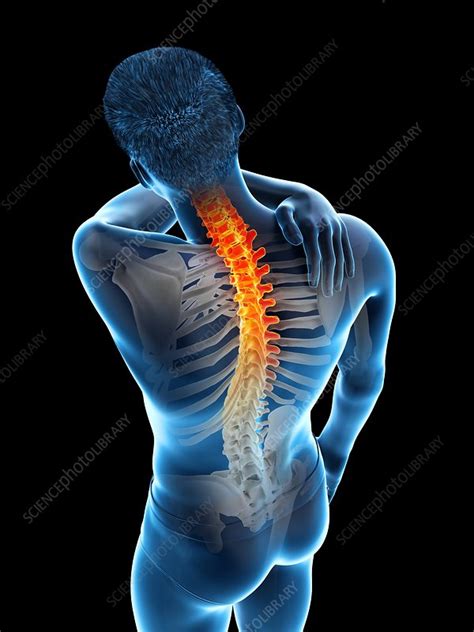 Back Pain Conceptual Illustration Stock Image F0257666 Science