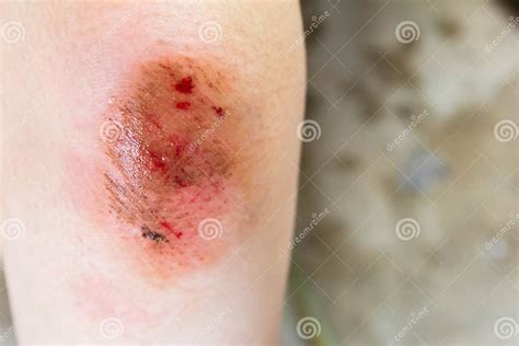 Bruised Wound Injury On Woman Knee Stock Image Image Of Insurance