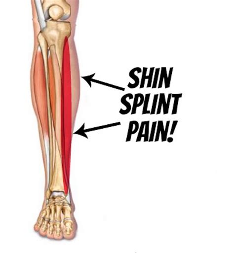 Talar stress fracture the talus bone is the bone at the top of the ankle which the tibia or shin bone sits on. Shin Busters! What are "Shin Splints" and How You Can Fix ...
