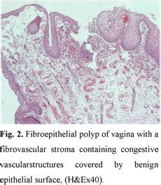Fibroepithelial Polyp Of Vagina In A Two Year Old Girl And Review Of