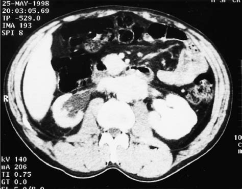 Ct Scan Showing Retroperitoneal Mass Causing Bilateral Urinary Tract