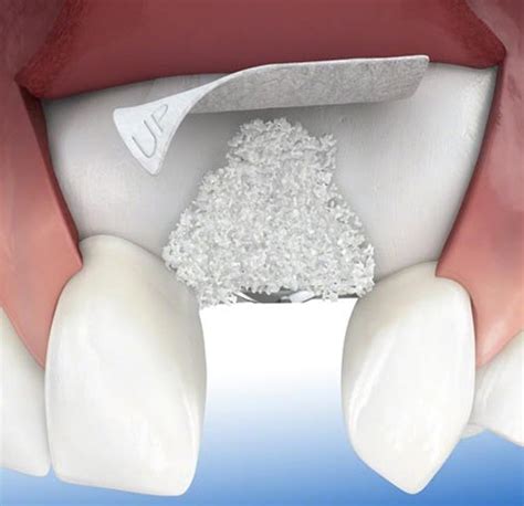 Bone And Gum Grafting Toronto Periodontal Grafts Dr Jon Perlus