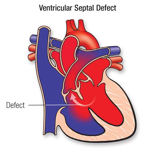 Ventricular Septal Defect VSD American Stroke Association