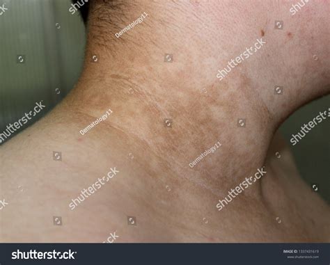 30 Acanthosis Nigricans Images Stock Photos And Vectors Shutterstock