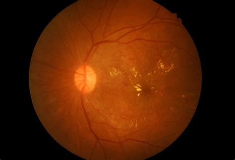 Predominantly Peripheral Lesions May Foretell Severity Of Diabetic