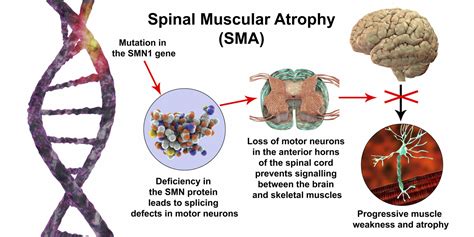 Spinal Muscular Atrophy Pathophysiology Rare Disease Advisor