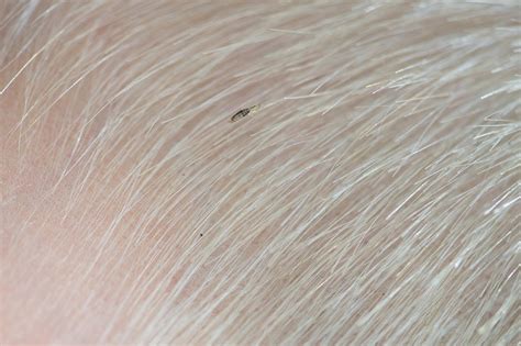 How To Identify Lice In Hair Dorado Ricated