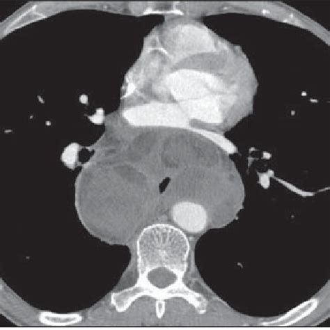 Contrast Enhanced Axial Ct Scan Showing A Large Lobulated Mass With