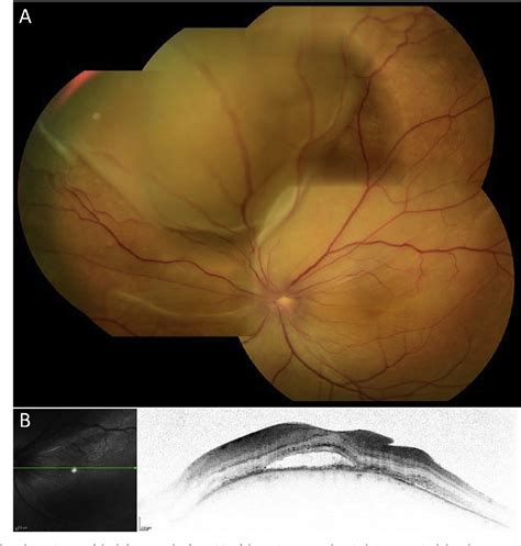 Figure 1 From Unilateral Serous Retinal Detachment With Choroidal