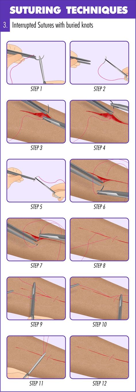 Complete Guide To Mastering Suturing Techniques