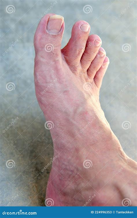 Asian Man Foot With Dry Skin Toenail Fungus Health Concept Stock