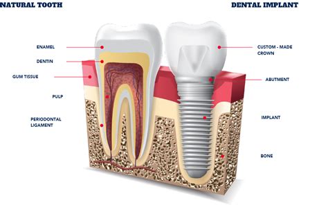 Low Cost Dental Implants in Costa Rica | Star Dental
