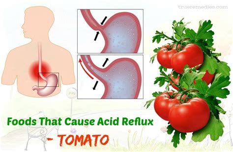 List Of 14 Foods That Cause Acid Reflux Gas And Indigestion