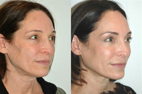 Before And After Ultherapy Shots The Beauty Wall