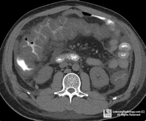 Buckeye Surgeon Clostridial Difficile Colitis