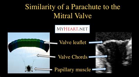 The Flail Leaflet And Mitral Valve Prolapse Mitral Valve Mitral Valve