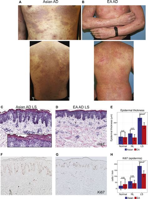 The Asian Atopic Dermatitis Phenotype Combines Features Of Atopic