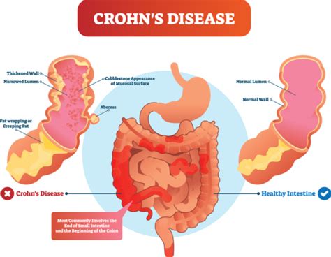Crohns Disease Explained Parkland Natural Health In London