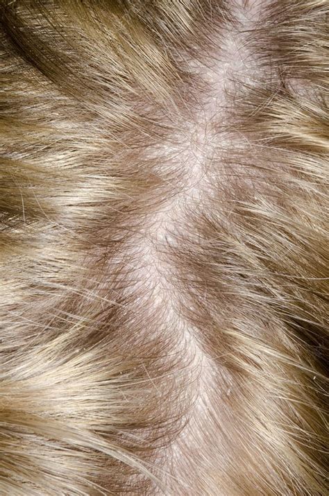 Psoriasis Of The Scalp Stock Image C0130974 Science Photo Library