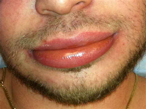 Oorzaken En Behandeling Van Gezwollen Lippen Mens Gezondheid