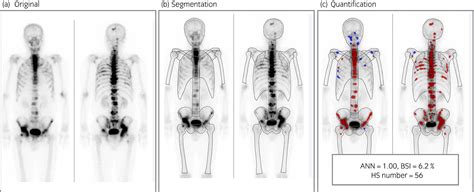 Bone Scan Index A New Biomarker Of Bone Metastasis In Patients With Prostate Cancer Nakajima