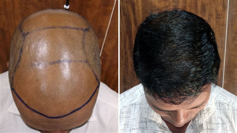 Hair Transplant Result After 8 Months Grade 6 Baldness Confidence Restored 😎🔥 Youtube