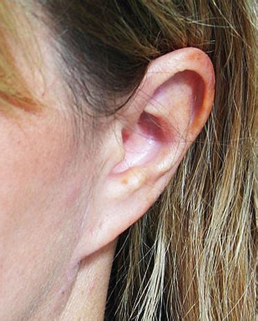 The pixie ear deformity can be recognized by its stuck on or pulled appearance, which is caused by the tension involving the facelift cheek and jawline skin flaps at the earlobe attachment point. Pixie Ear - Plastic Surgery: 10 Secret Signs - Pictures ...