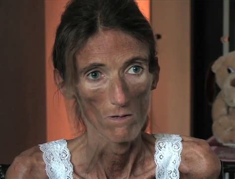 Dying To Be Thin An Extreme Anorexic Speaks Out