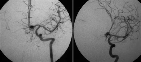 Left Internal Carotid Artery Angiogram Showing An Anterior