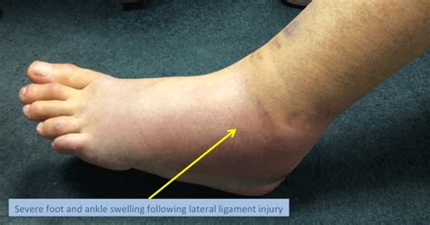 Lateral Ankle Injury Ankle Sprain The London Foot And Ankle Clinic