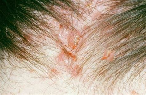 Raised Bumps On Scalp Pictures Photos