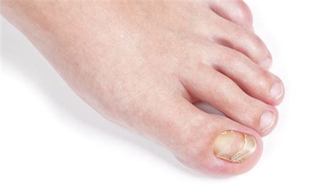 Types Of Fungal Nail Infection Home Interior Design