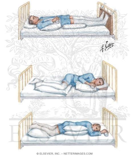 Positioning In Bed After Stroke