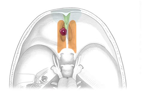 Use Of Endoscopes In Skull Base Surgery Skull Base Surgery Atlas