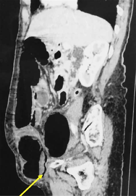 Abdominal Ct Scan Showing A Strangulated Right Spigelian Hernia With