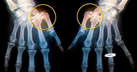 Webmd On Twitter The Most Common Places For Hand Osteoarthritis Are